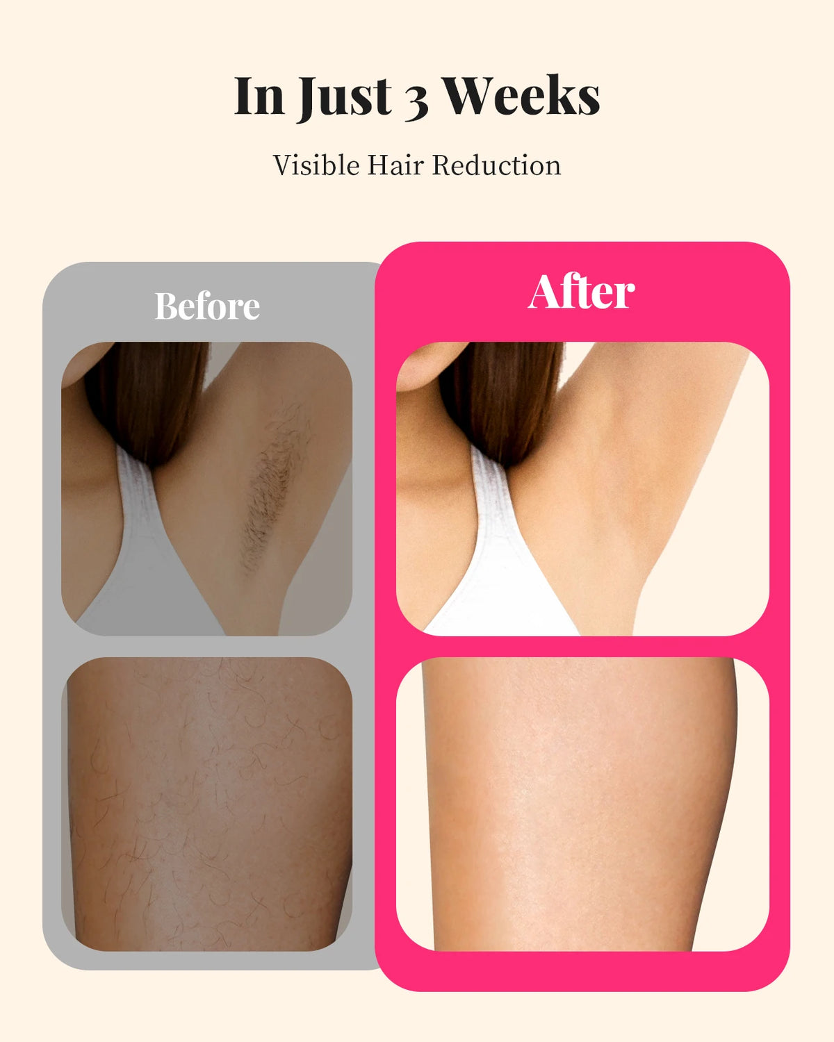 Hair Removal